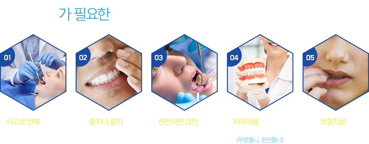 임플란트가 필요한 경우